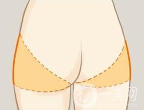 360度環(huán)形吸脂疼不疼？是全麻嗎？