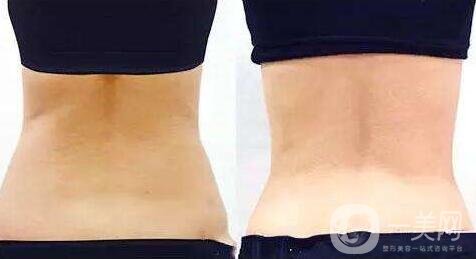 360度吸脂減肥是指環(huán)吸還是水動力？