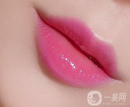 玻尿酸豐唇珠能夠保持多久？需要繼續(xù)注射嗎？