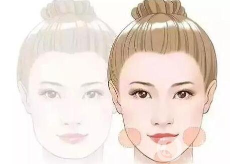 玻尿酸豐臉頰多少錢?與部位多少有關(guān)嗎?