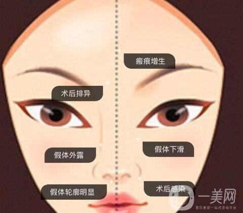 墊高鼻子的風(fēng)險(xiǎn)有多大?后遺癥有哪些?