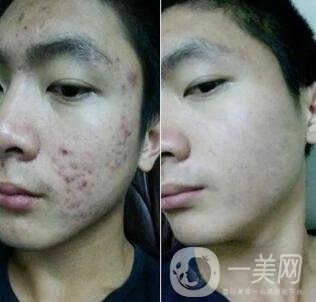 自體細胞注射去痘坑