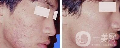 自體細胞注射去痘坑