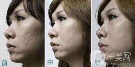 自體細胞注射去痘坑