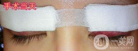 雙眼皮手術(shù)