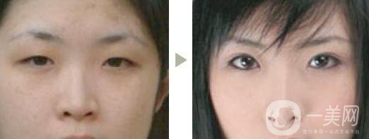 做雙眼皮手術(shù)