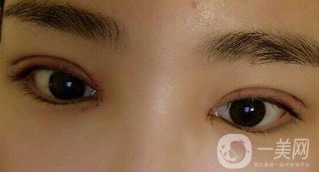 做雙眼皮手術(shù)