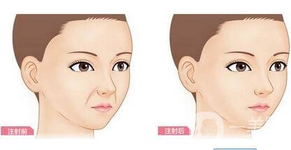 注射豐鼻唇溝*果*嗎？能立馬*果嗎？