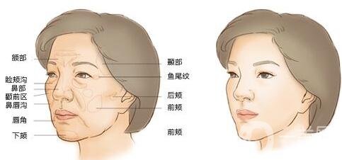 注射豐鼻唇溝*果*嗎？能立馬*果嗎？