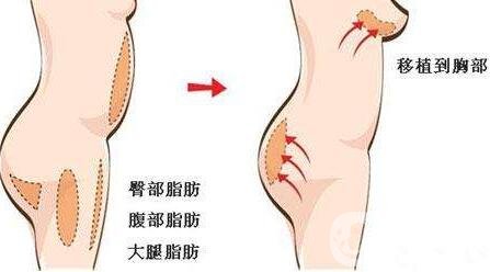 自身脂肪移植隆胸術(shù)有沒有副作用？