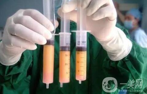 全身抽脂手術(shù)要多長時(shí)間，會全麻嗎?