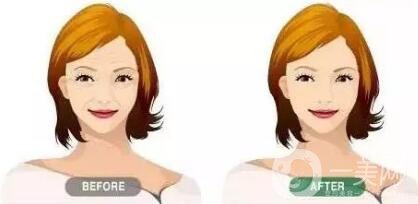 提升除皺手術(shù)多少錢?價格會有變化嗎