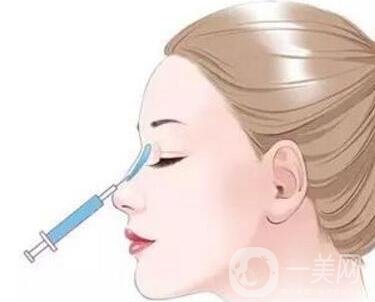 伊凡露注射隆鼻的*果能維持多久?需要注意什么嗎