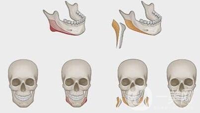 磨下頜角價(jià)格是不是很貴？一般要多少錢？