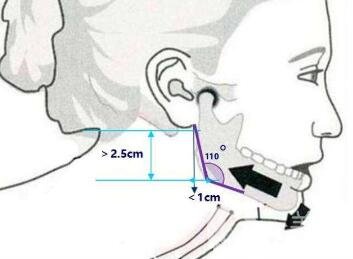 磨下頜角價(jià)格是不是很貴？一般要多少錢？