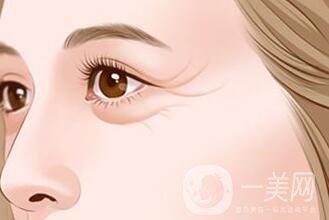 去除魚尾紋的方法有哪些？哪種方法比較好？