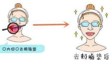 去頰脂墊價格貴嗎？大概價位是多少？