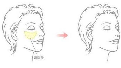 去頰脂墊價格貴嗎？大概價位是多少？