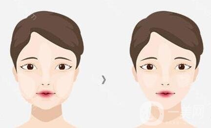 去頰脂墊價格貴嗎？大概價位是多少？