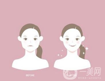 去頰脂墊有副作用嗎？術后如何護理可以減小副作用？