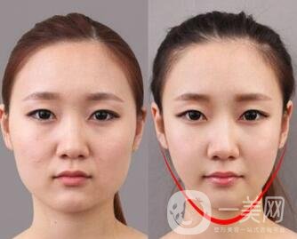 去頰脂墊有副作用嗎？術后如何護理可以減小副作用？