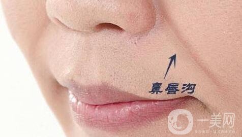 玻尿酸豐鼻唇溝能維持多長時(shí)間?