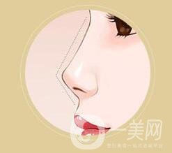 朝天鼻整形價格貴嗎?大概要多少錢?