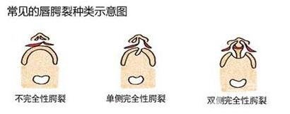 唇裂手術多少錢?一般唇裂手術要多少錢?