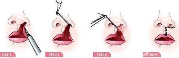 唇裂手術多少錢?一般唇裂手術要多少錢?