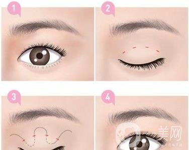 *需要拆線嗎？多長時間可以碰水？