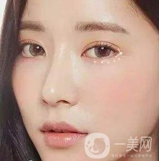 *需要拆線嗎？多長時間可以碰水？