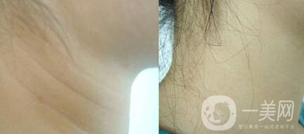 頸部除皺提升術(shù)