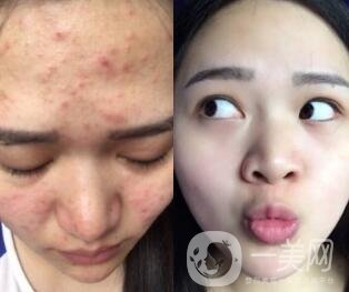藍(lán)光祛痘