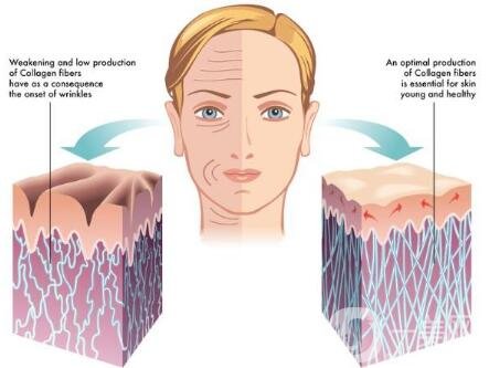 冰電波拉皮除皺*果如何？有哪些優(yōu)點(diǎn)？