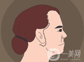 冰電波拉皮除皺*果如何？有哪些優(yōu)點(diǎn)？