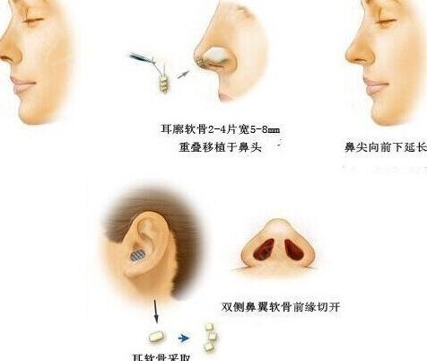 鼻尖美容術是怎樣做的?詳細解析公布