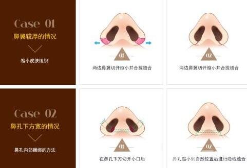 鼻頭縮小手術(shù)價格是多少?價格受什么因素影響