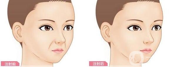 鼻唇溝填充術(shù)一般用什么材料?哪種材料比較好?