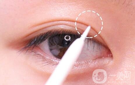 做雙眼皮手術(shù)過(guò)程