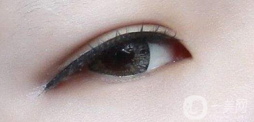 做雙眼皮手術(shù)過(guò)程