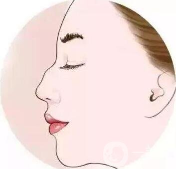 如何讓鼻梁變高？可以注射玻尿酸嗎？