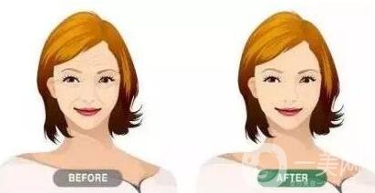 瑞蘭玻尿酸注射除皺價(jià)格要多少錢？