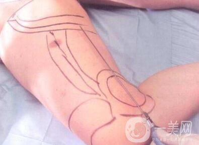 吸脂減肥*嗎？有危險(xiǎn)嗎？