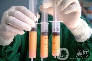 吸脂減肥*嗎？有危險(xiǎn)嗎？