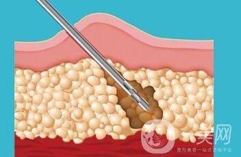 吸脂減肥*嗎？有危險(xiǎn)嗎？