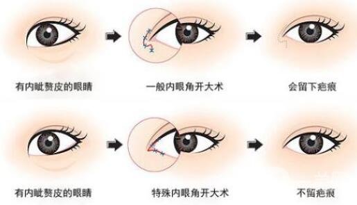 開內(nèi)眼角