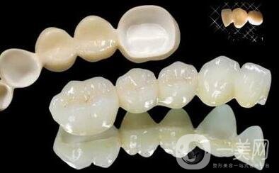 貴金屬烤瓷牙有哪些種類(lèi)？
