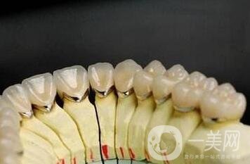 貴金屬烤瓷牙有哪些種類(lèi)？