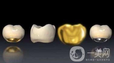 貴金屬烤瓷牙有哪些種類(lèi)？