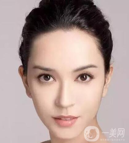 取出隆鼻假體*嗎?需要多少錢(qián)?